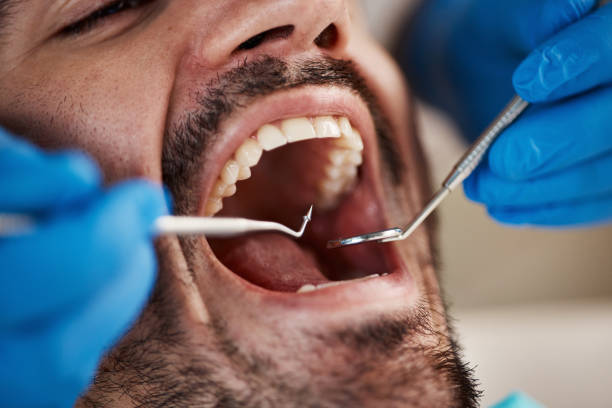 Best Emergency Wisdom Teeth Removal in Old Saybrook Center, CT